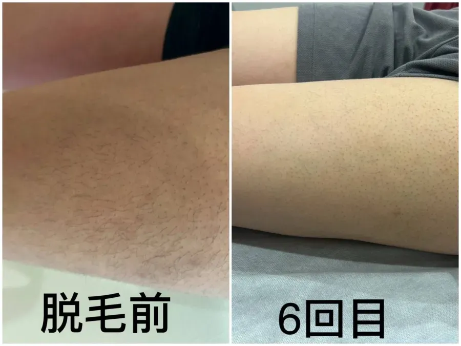 ちゃんと脱毛したい、新規の方にオススメ！