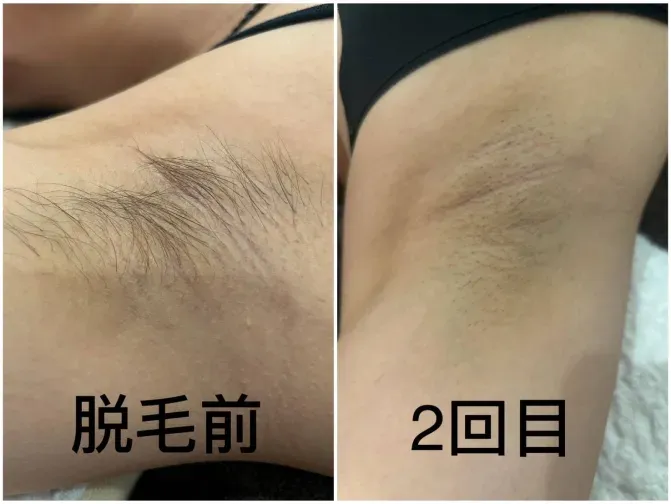 この夏、脇脱毛はじめてみませんか？？
